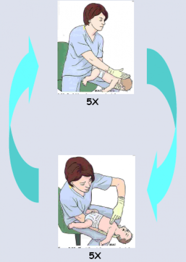 Reanimação de bebé engasgado