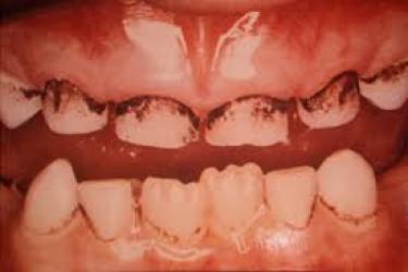 dentes com pontos negros